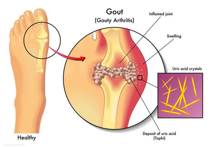 Get Rid of Gout Crystals - Consultant Rheumatologist Dr. Schreiber